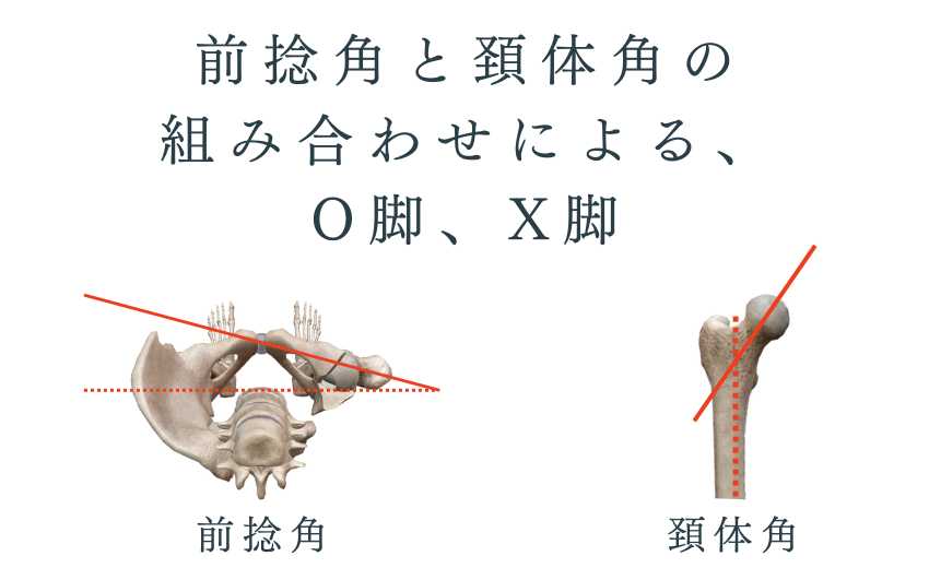 前捻角と頚体角の組み合わせによる、O脚・X脚