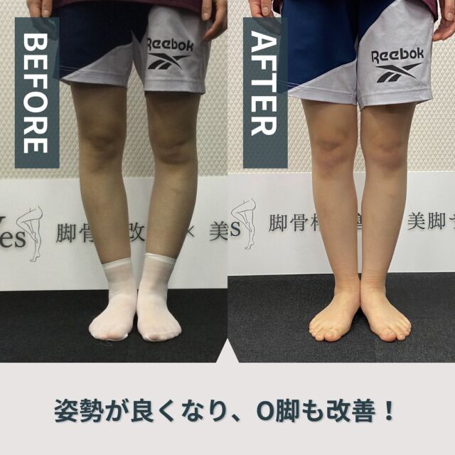👈他の投稿もチェック✨
⁡
脚矯正
BEFORE&AFTER
⁡
【膝骨格のゆがみ診断】
・O脚
・膝下O脚 
・足関節のゆがみ有り
⁡
【膝骨格のゆがみ改善方法】 
O脚
・臀部深層筋の促通 
・姿勢意識改善
膝下O脚
・膝の内捻れエクササイズ 
・足首の柔軟性UP
足関節のゆがみ
・柔軟性UP 
・正しい歩行獲得
⁡
⁡
脚骨格を整えるだけで、姿勢も良くなります。 これは土台が良くなることによる、 改善連鎖。 ほとんどの方が効果を実感されます。
⁡
˗˗˗˗˗˗˗˗˗˗˗˗˗˗˗˗˗˗˗˗˗˗˗˗˗˗˗˗˗˗˗˗˗˗˗˗˗˗˗˗˗
理想の美脚のために、特別な施術を
その思いを
骨格改善という 形に変えて最適なプログラムを提供いたします。
脚骨格改善【美脚サロン】新宿Ves(ビース)
✨👈
⁡
 お気軽にお問い合わせください
@ves_bikyaku_salon
˗˗˗˗˗˗˗˗˗˗˗˗˗˗˗˗˗˗˗˗˗˗˗˗˗˗˗˗˗˗˗˗˗˗˗˗˗˗˗˗˗
下半身太り、脚骨格の原因は一つではなく 
✶ 立ち方
✶ 歩き方
✶ 足裏の体重の乗せ方
✶ 股関節のねじれ 
✶ 足首のねじれ
などが複雑に絡み合っています。
Vesではその原因を最新技術でスクリーニングテストをおこない、 誰でも理解できるように分かりやすく伝えて、理想の脚になるようにレクチャーしていきます。
⁡
施術内容は、筋膜リリース、ストレッチ、セルフエクササイズ、パートナーエクササイズで包括的に アプローチします。
⁡
#O脚矯正 #XO脚矯正 #膝下O脚 #骨盤 #骨盤矯正 #骨盤調整 #骨格ダイエット #美脚ストレッチ #美脚ダイエット #美脚トレーニング #美脚になりたい #vesビース #ves美脚 #大転子矯正 #外もも痩せ #美脚矯正 #矯正エクササイズ